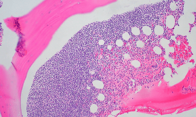 Bone Marrow Biopsy