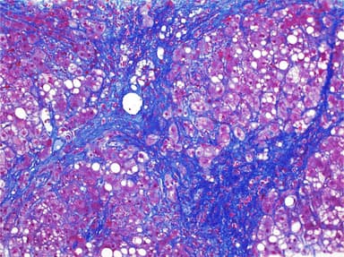 Liver Biopsy