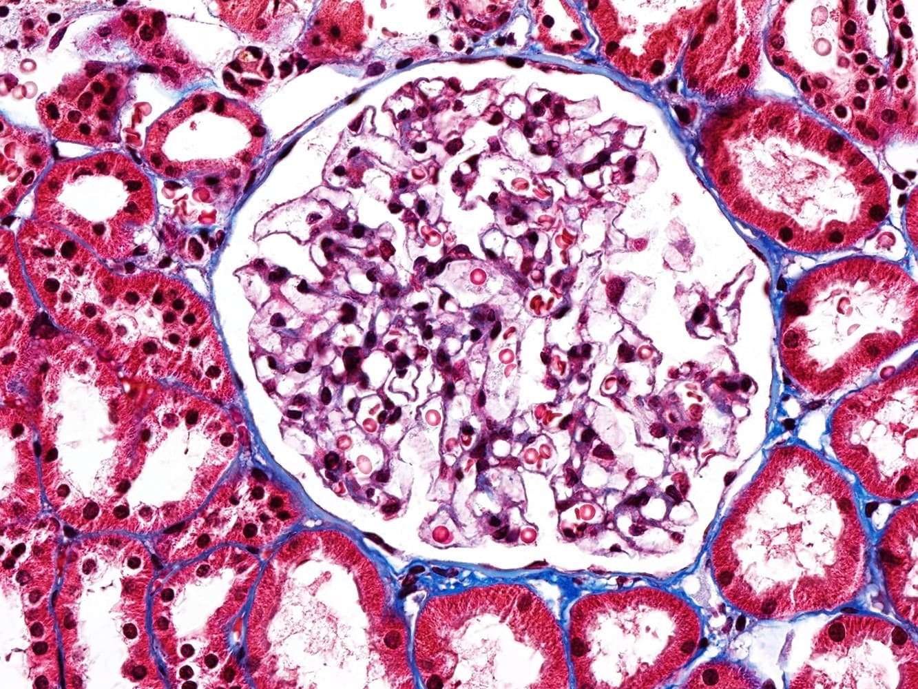 Renal Biopsy