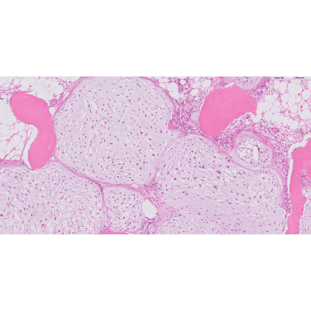 Chondrosarcoma