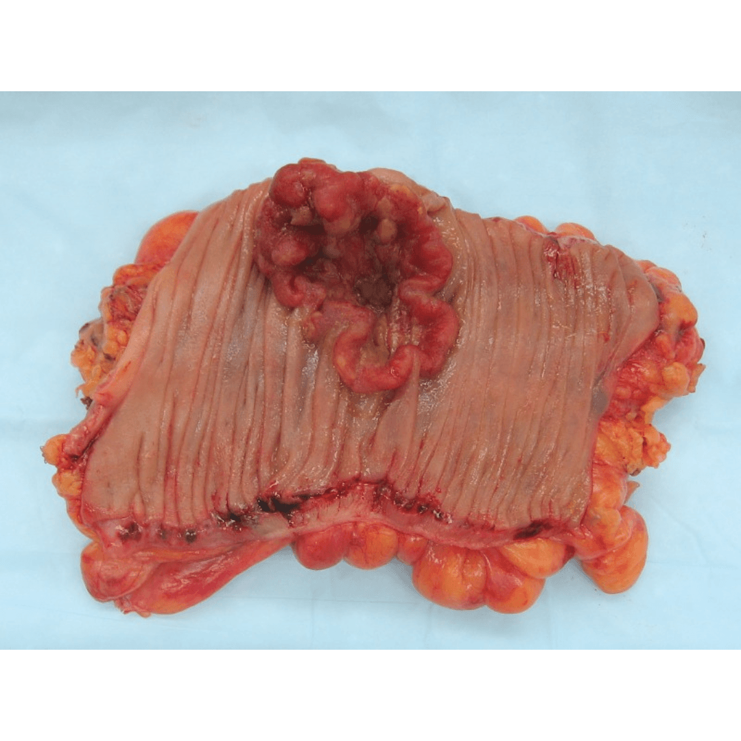 Colon cancer