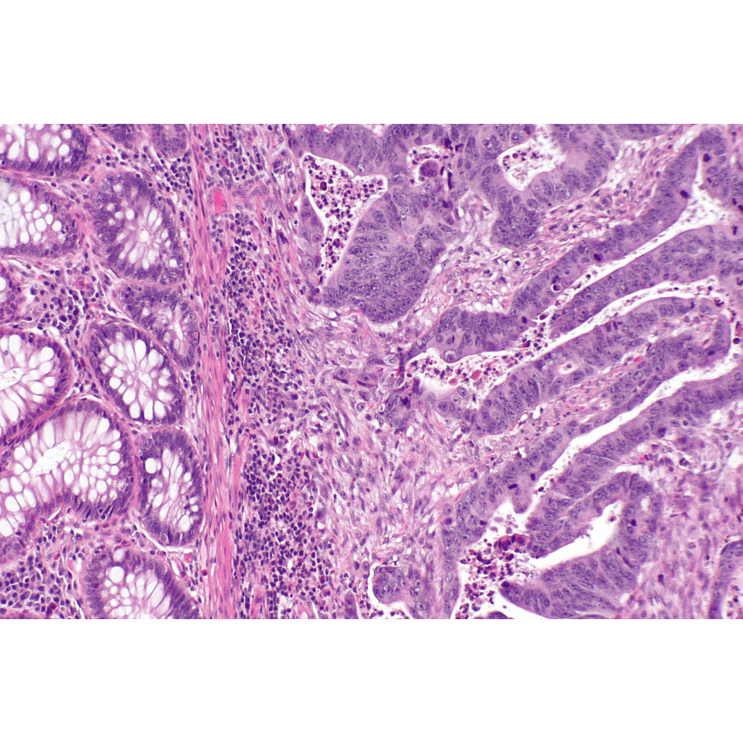 Colorectal cancer