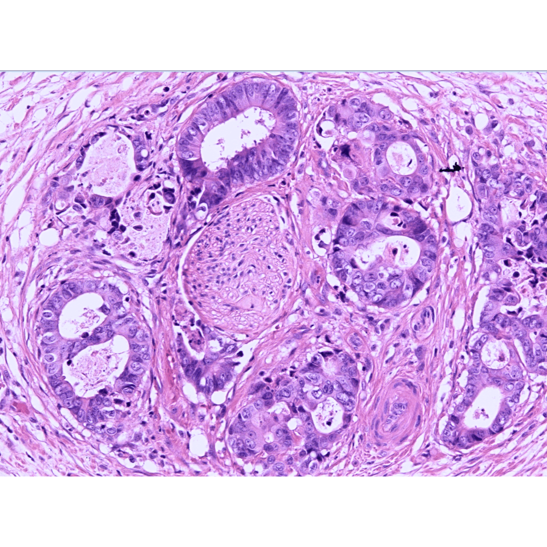 Perineural tumor invasion