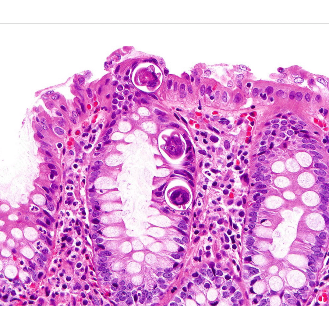 Schistosomiasis